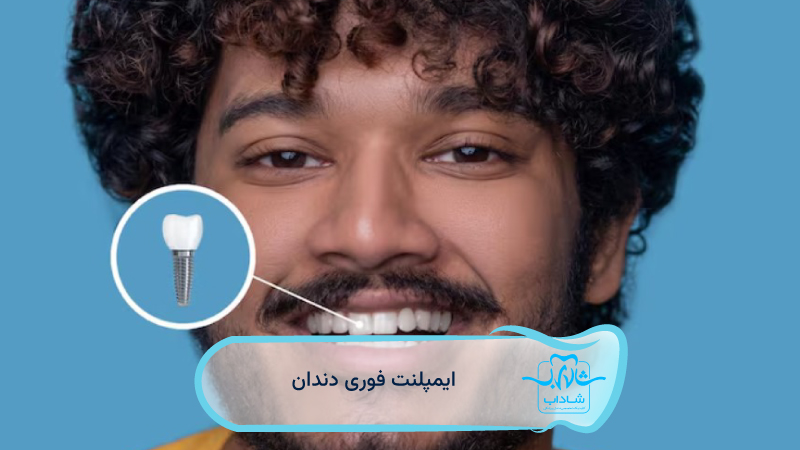 ایمپلنت-فوری-دندان