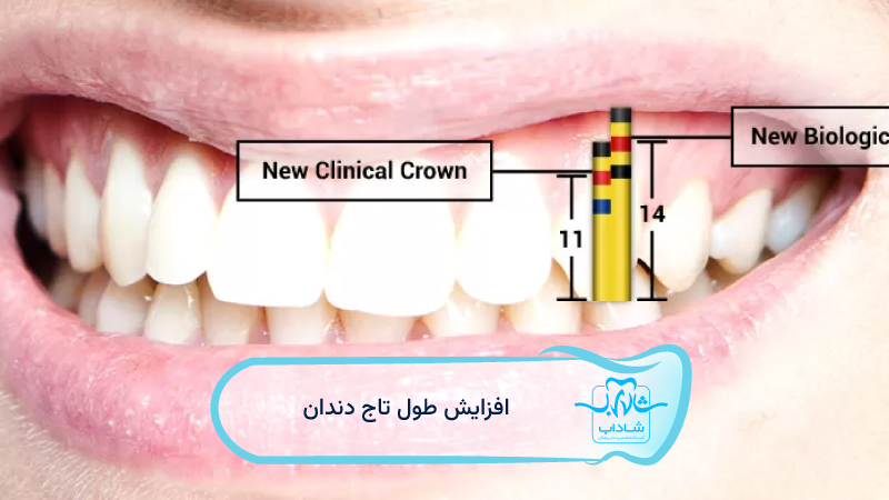 افزایش-طول-تاج-دندان