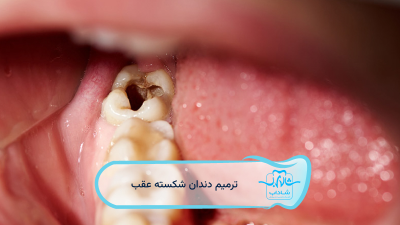 ترمیم-دندان-شکسته-عقب