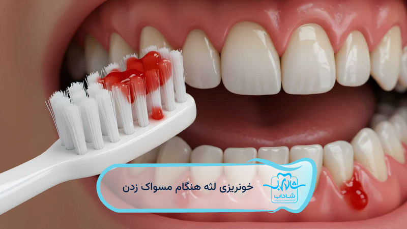 خونریزی-لثه-هنگام-مسواک-زدن