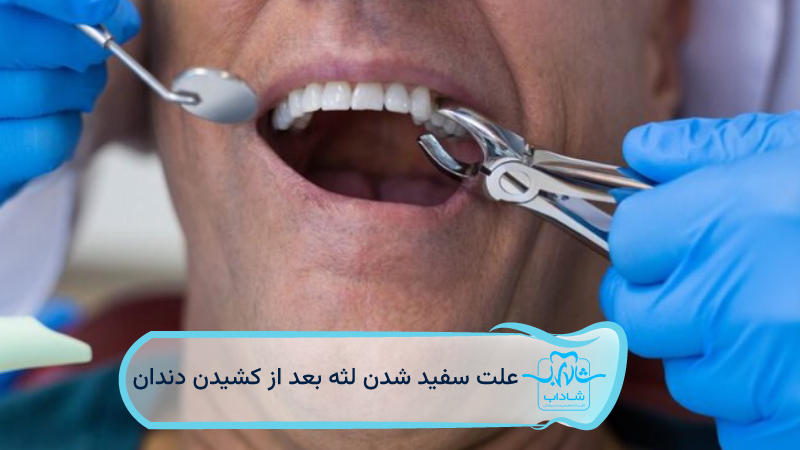 علت-سفید-شدن-لثه-بعد-از-کشیدن-دندان