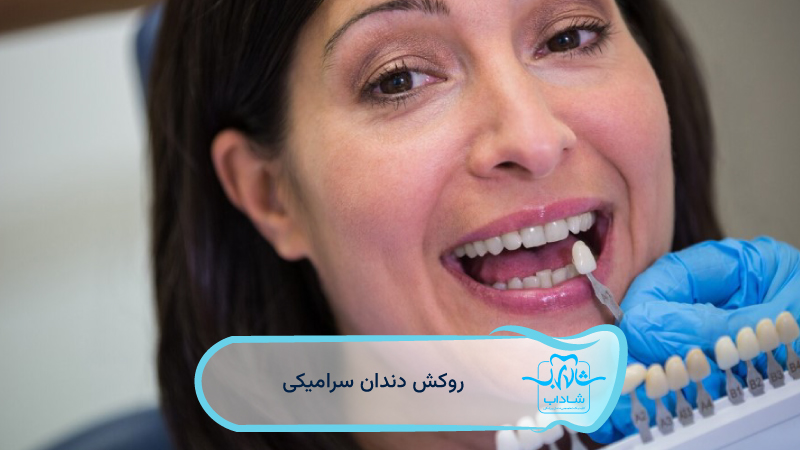 روکش-دندان-سرامیکی
