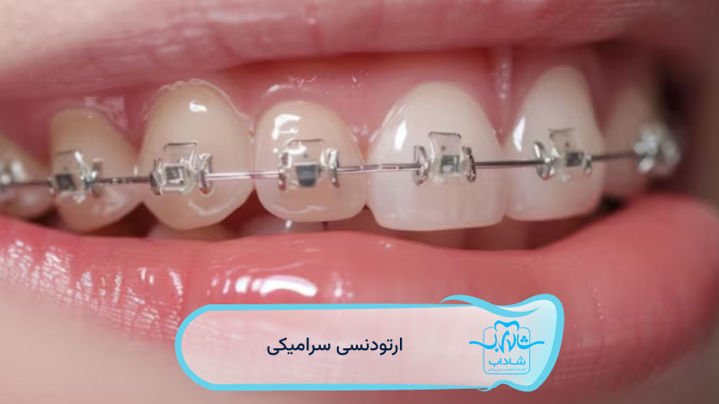 ارتودنسی-سرامیکی