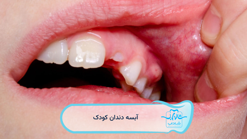 آبسه-دندان-کودک