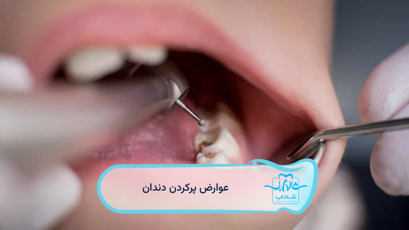 عوارض-پر-کردن-دندان