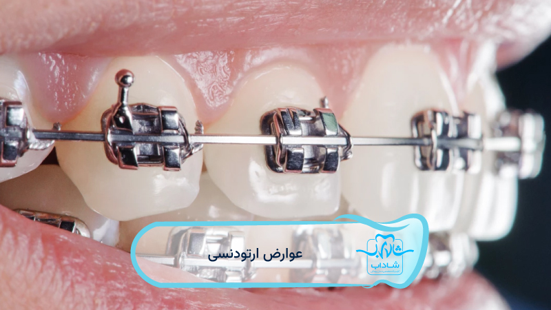 عوارض-ارتودنسی-دندان
