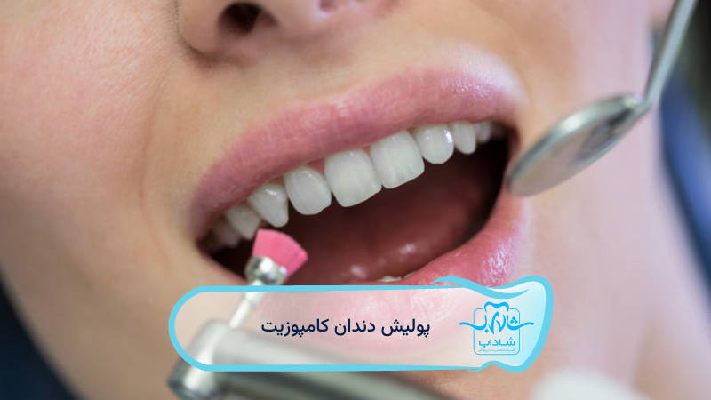 پولیش-دندان-کامپوزیت