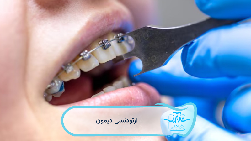 ارتودنسی-دیمون