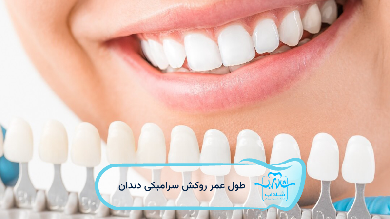 -طول-عمر-روکش-سرامیکی-دندان