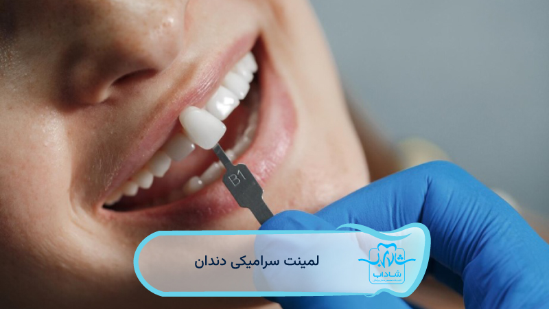 لمینت-سرامیکی-دندان