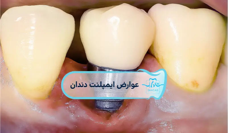 عوارض-ایمپلنت-دندان