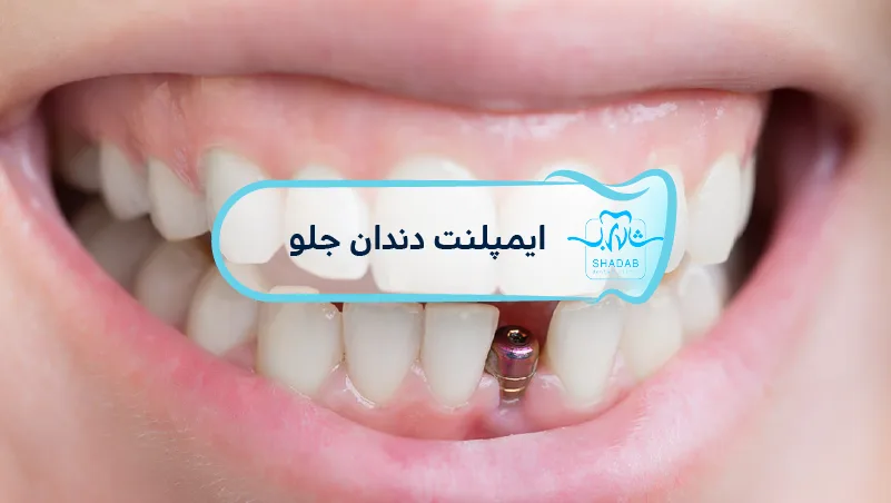 ایمپلنت-دندان-جلو