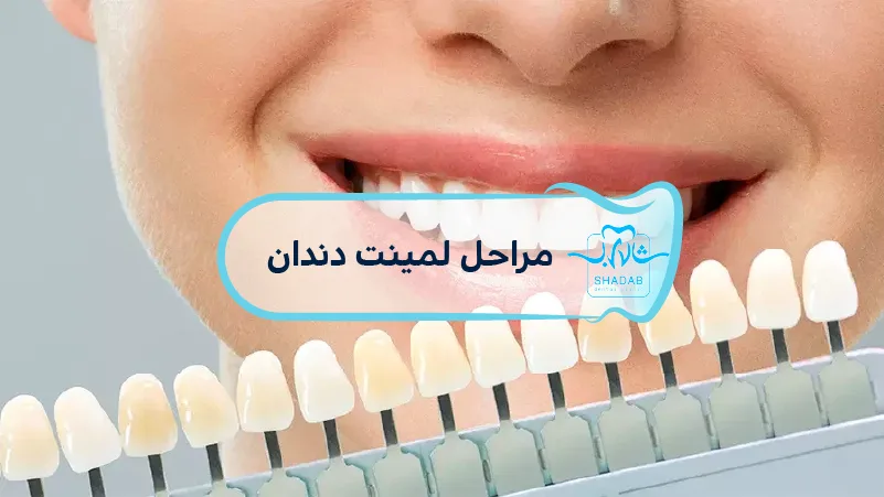 مراحل-لمینت-دندان