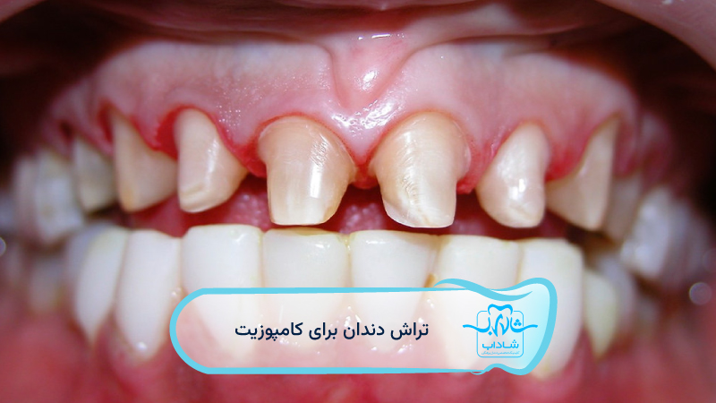 تراش-دندان-برای-کامپوزیت