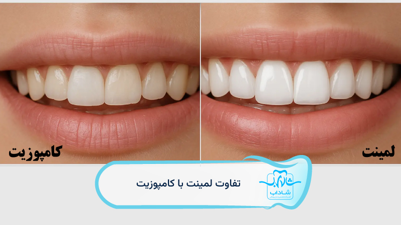 فرق-لمینت-و-کامپوزیت-دندان-چیست؟