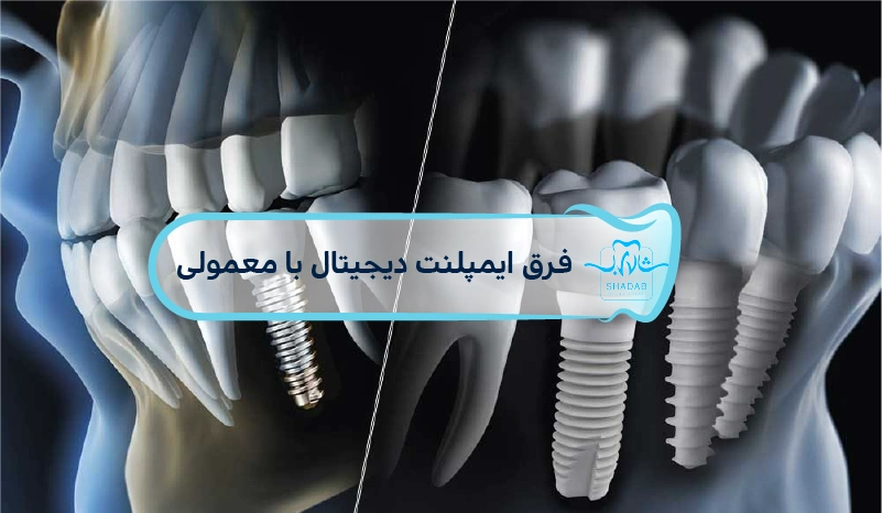 فرق-ایمپلنت-دیجیتال-با-معمولی