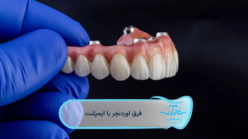 فرق-اوردنچر-با-ایمپلنت