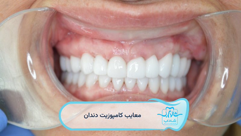 معایب-کامپوزیت-دندان