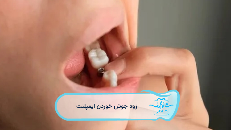 زود-جوش-خوردن-ایمپلنت