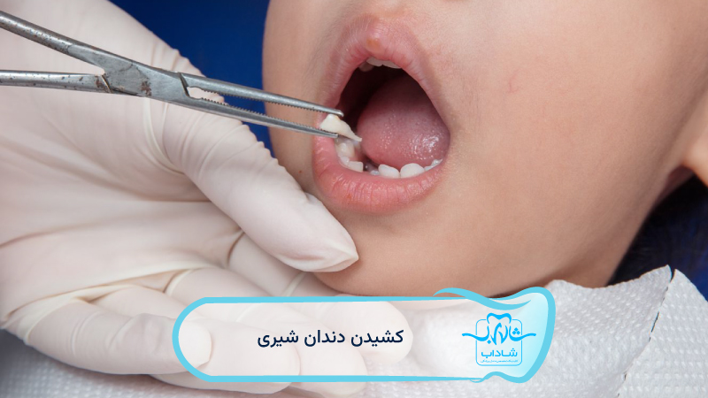 کشیدن-دندان-شیری