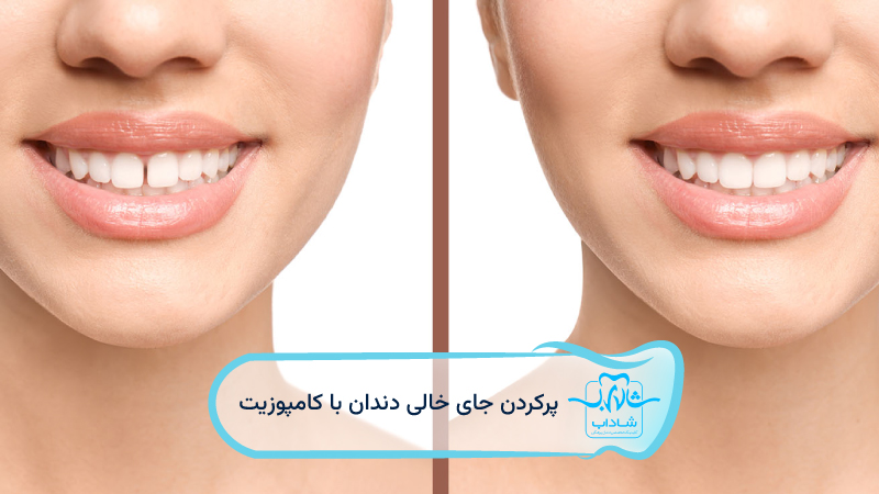 پر-کردن-جای-خالی-دندان-با-کامپوزیت