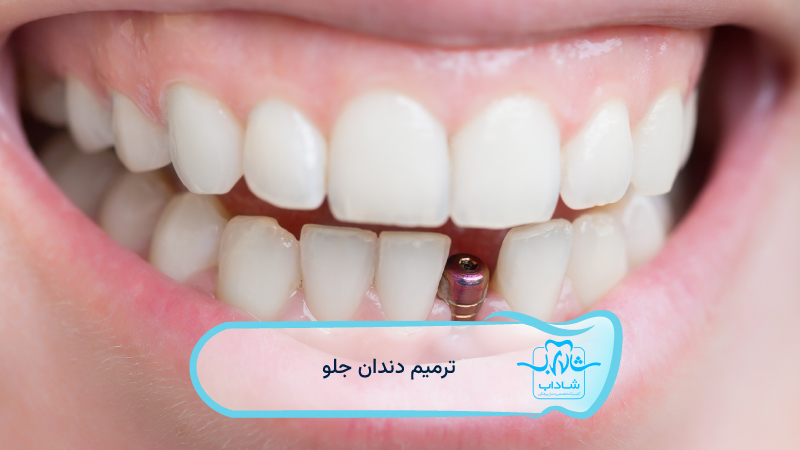 ترمیم-دندان-جلو