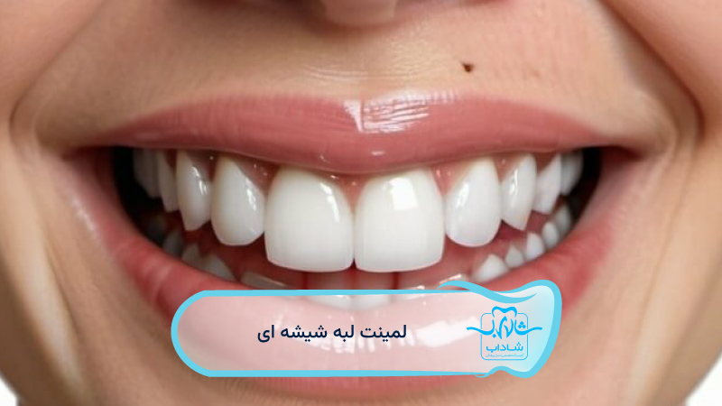 لمینت-لبه-شیشه‌-ای