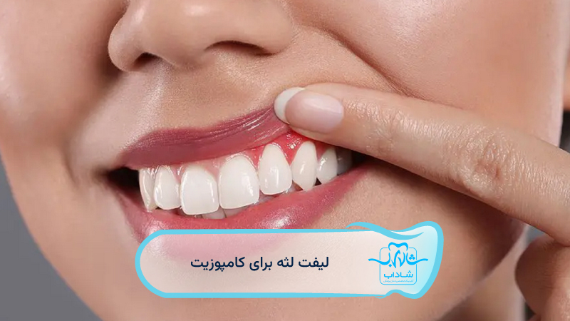 لیفت-لثه-برای-کامپوزیت