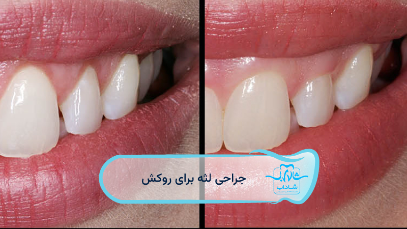 جراحی-لثه-برای-روکش