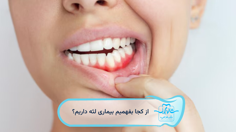 از-کجا-بفهمیم-بیماری-لثه-داریم