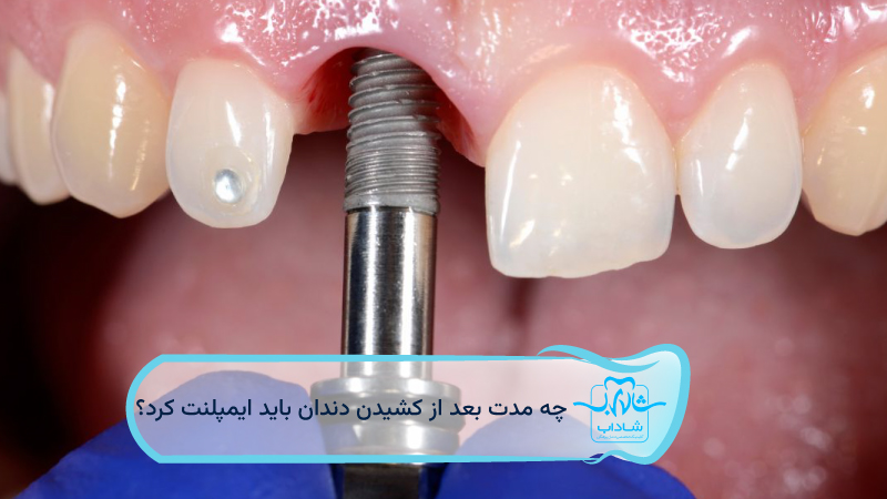 چه-مدت-بعد-از-کشیدن-دندان-باید-ایمپلنت-کرد