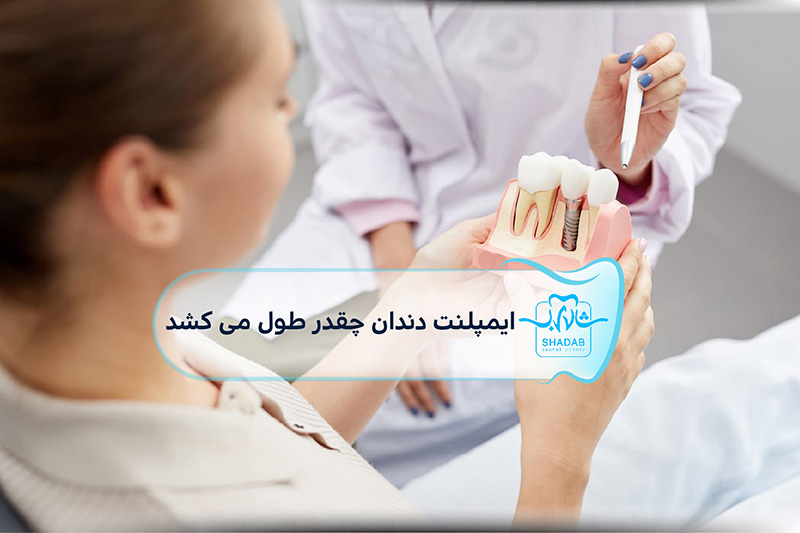 ایمپلنت-دندان-چقدر-طول-می-کشد