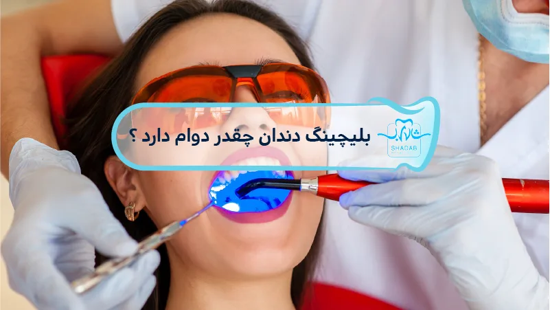 بلیچینگ-دندان-چقدر-دوام-دارد
