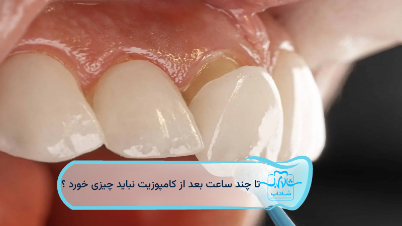 تا-چند-ساعت-بعد-از-کامپوزیت-نباید-چیزی-خورد