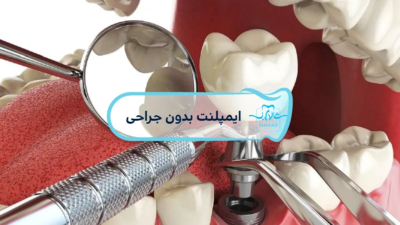 -ایمپلنت-بدون-جراحی	