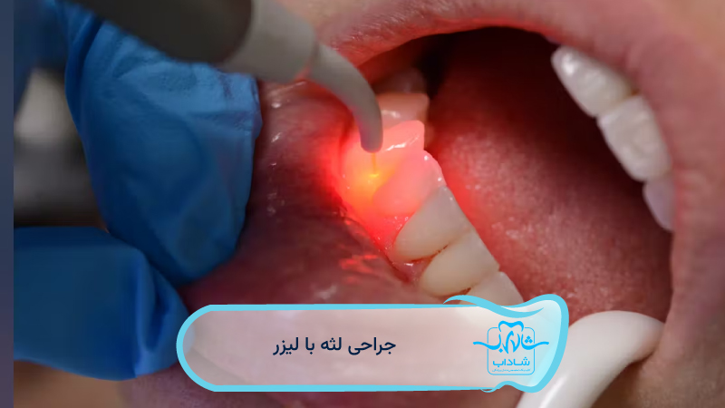 جراحی-لثه-با-لیزر