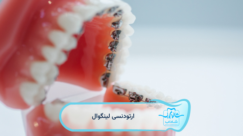 ارتودنسی-لینگوال