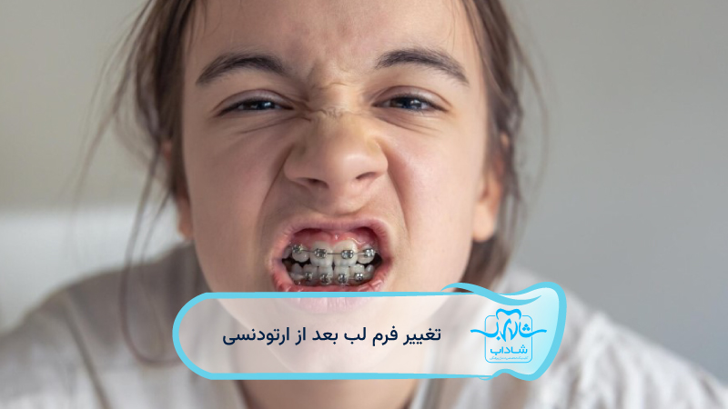 تغییر-فرم-لب-بعد-از-ارتودنسی
