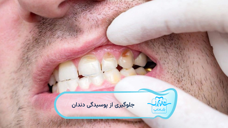 جلوگیری-از-پوسیدگی-دندان