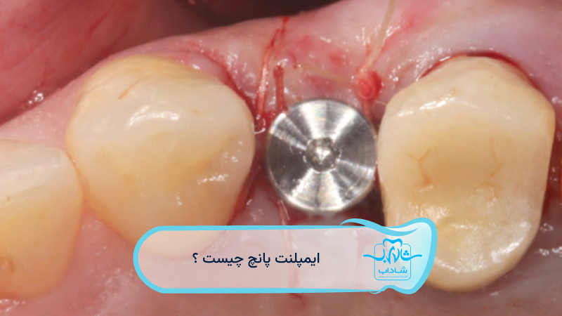 ایمپلنت-پانچ