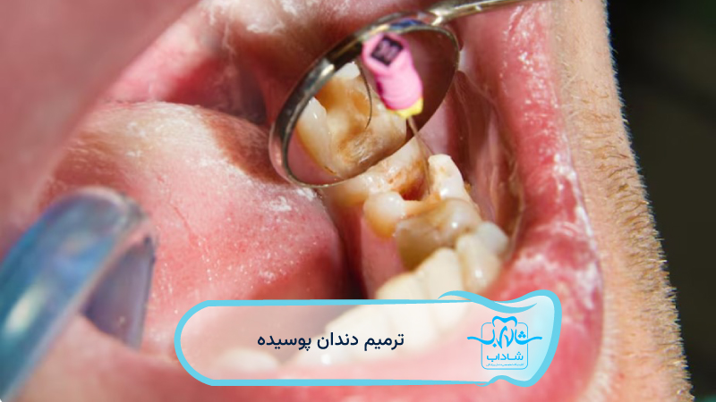 ترمیم-دندان-پوسیده