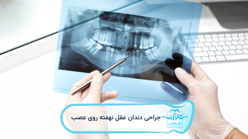 جراحی-دندان-عقل-نهفته-روی-عصب