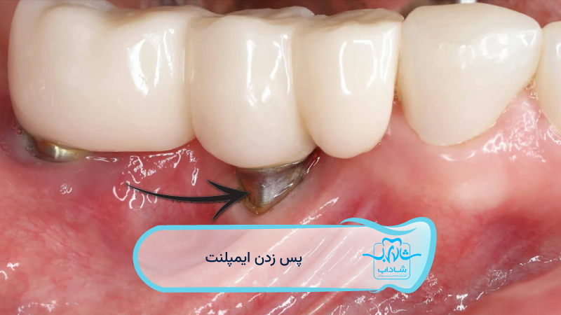 علائم-پس-زدن-ایمپلنت
