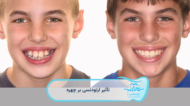 تاثیر-ارتودنسی-بر-چهره