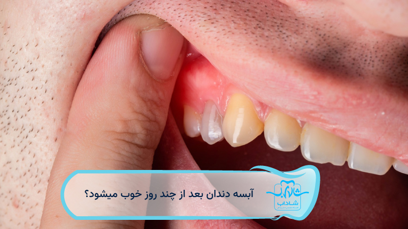 آبسه-دندان-بعد-از-چند-روز-خوب-میشود