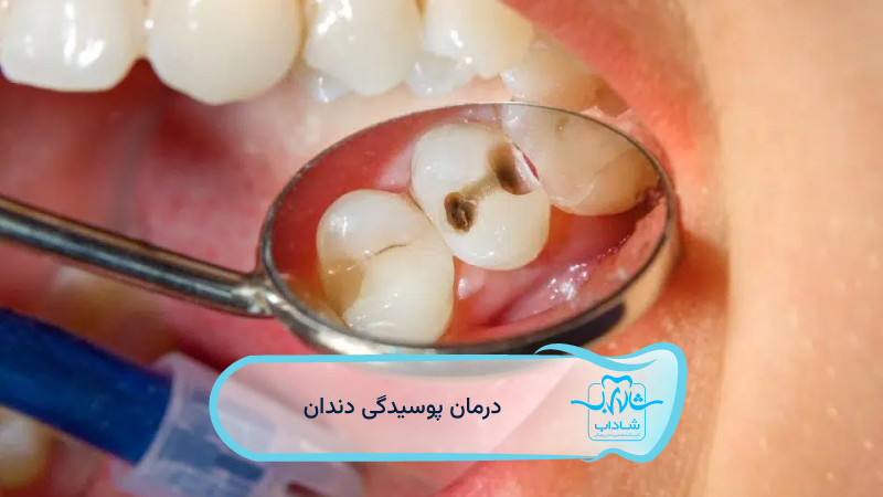 درمان-پوسیدگی-دندان