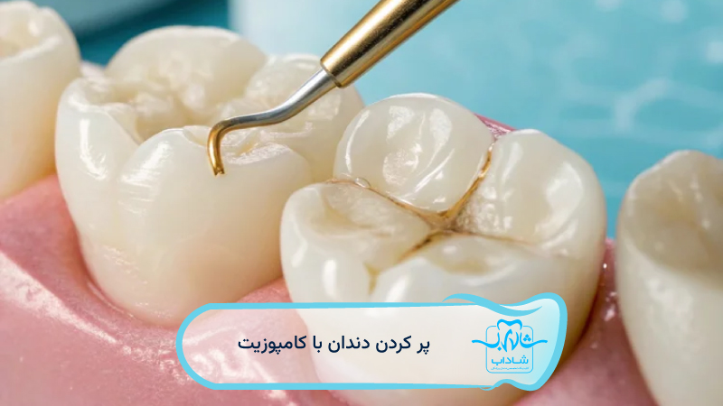 پر-کردن-دندان-با-کامپوزیت