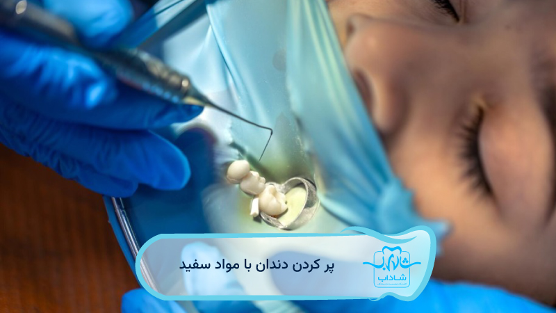 پر-کردن-دندان-با-مواد-سفید