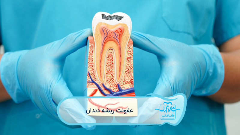 عفونت-ریشه-دندان