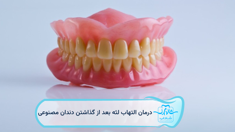 درمان-التهاب-لثه-بعد-از-گذاشتن-دندان-مصنوعی